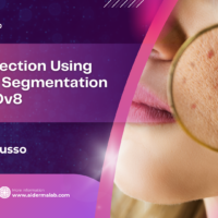 Acne Detection Using Instance Segmentation and YOLOv8