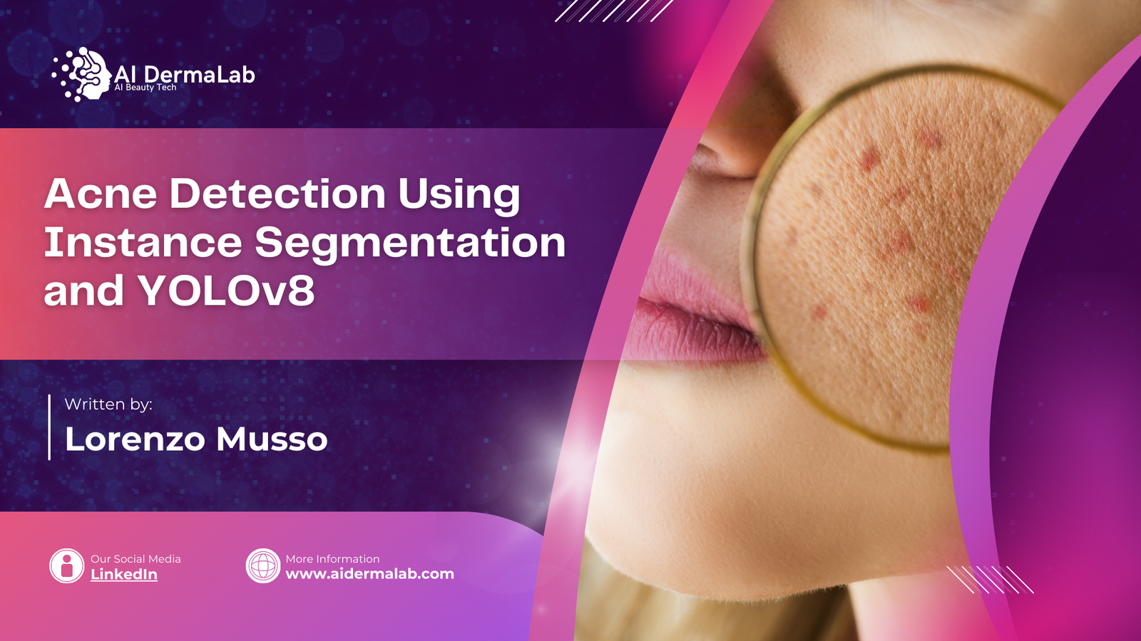 Acne Detection Using Instance Segmentation and YOLOv8